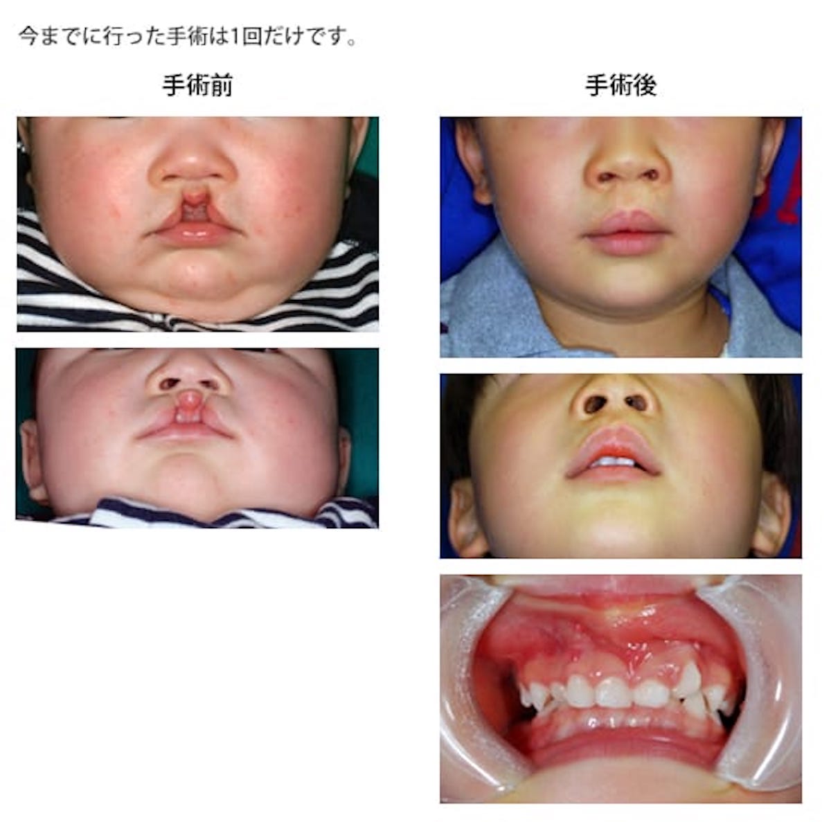 口唇裂・口蓋裂の治療:最近の進歩１
