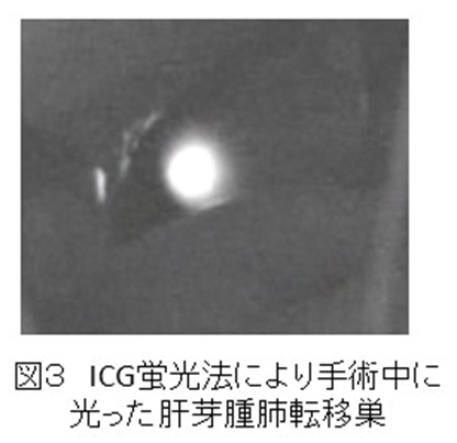ICG蛍光法により手術中に光った肝芽腫肺転移巣
